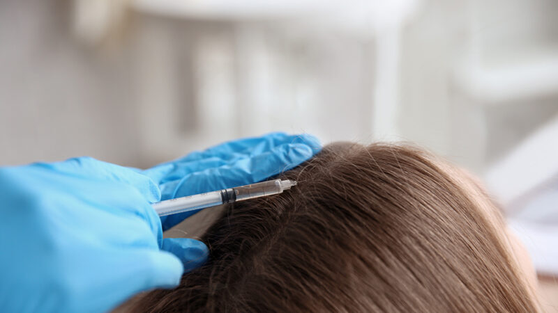 MESOTERAPIA CAPILAR